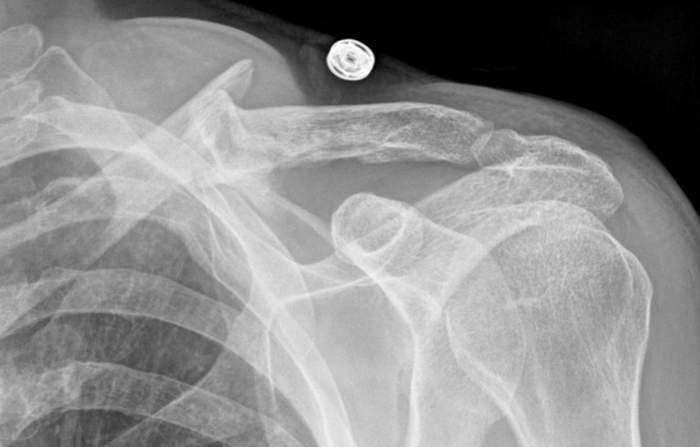ClaviclePart3-2015-1