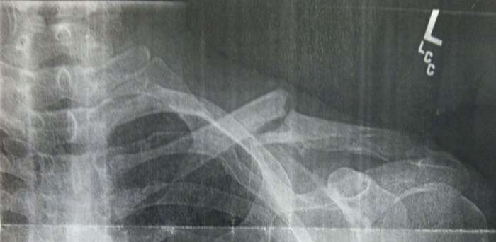 ClaviclePart3-2015-2