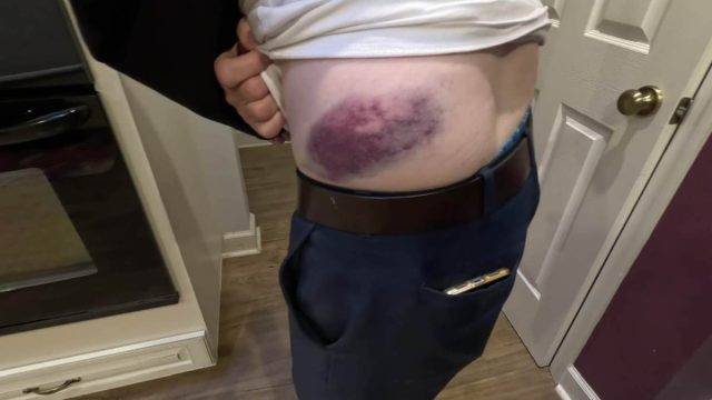 recovering from a collar bone injury